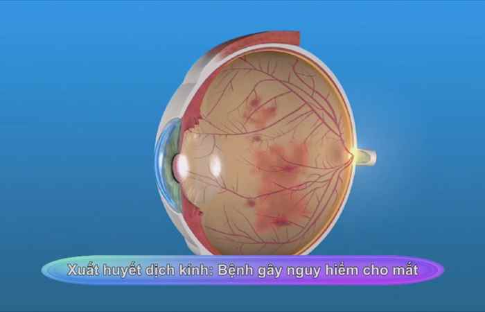 Sống khỏe 360 - Xuất huyết dịch kính - Bệnh gây nguy hiểm cho mắt  (03-03-2020)